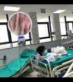 小宝宝脸上长白斑的原因